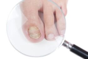 Causes de champignons à ongles