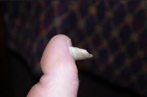 Symptômes de champignons sur les ongles