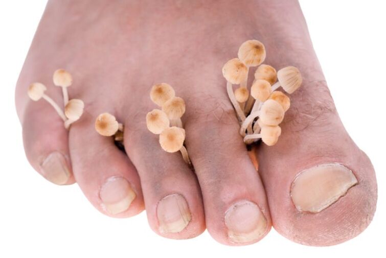 Mushroom sur les jambes Symptômes