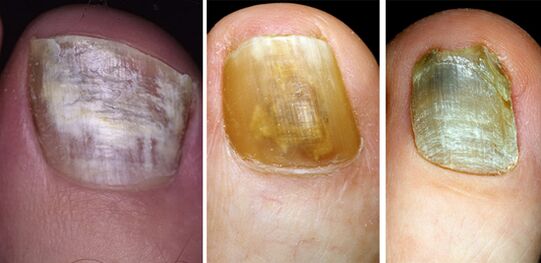 Sur la photo, un changement de couleur des ongles sur les jambes avec une maladie des champignons