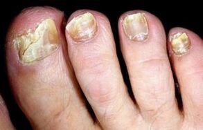 Symptômes de la mycose des ongles des pieds