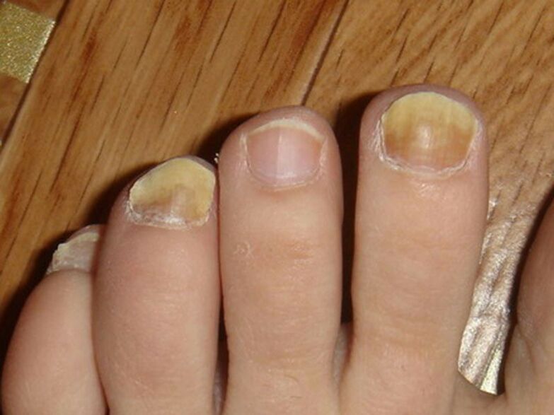 Infection fongique des ongles des pieds