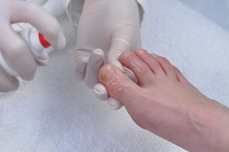Traitement de la plaque à ongles pour les infections fongiques